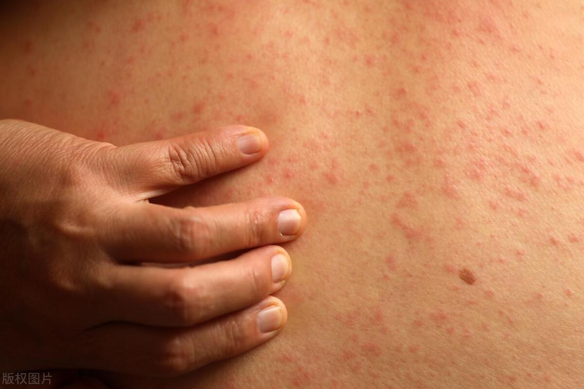 为老头身体着想买了蛋*粉白**，因老头过敏出现红疹，误以为染脏病