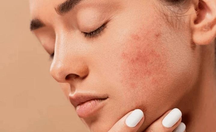 脸部晒伤如何快速修复退红,皮肤晒红急救