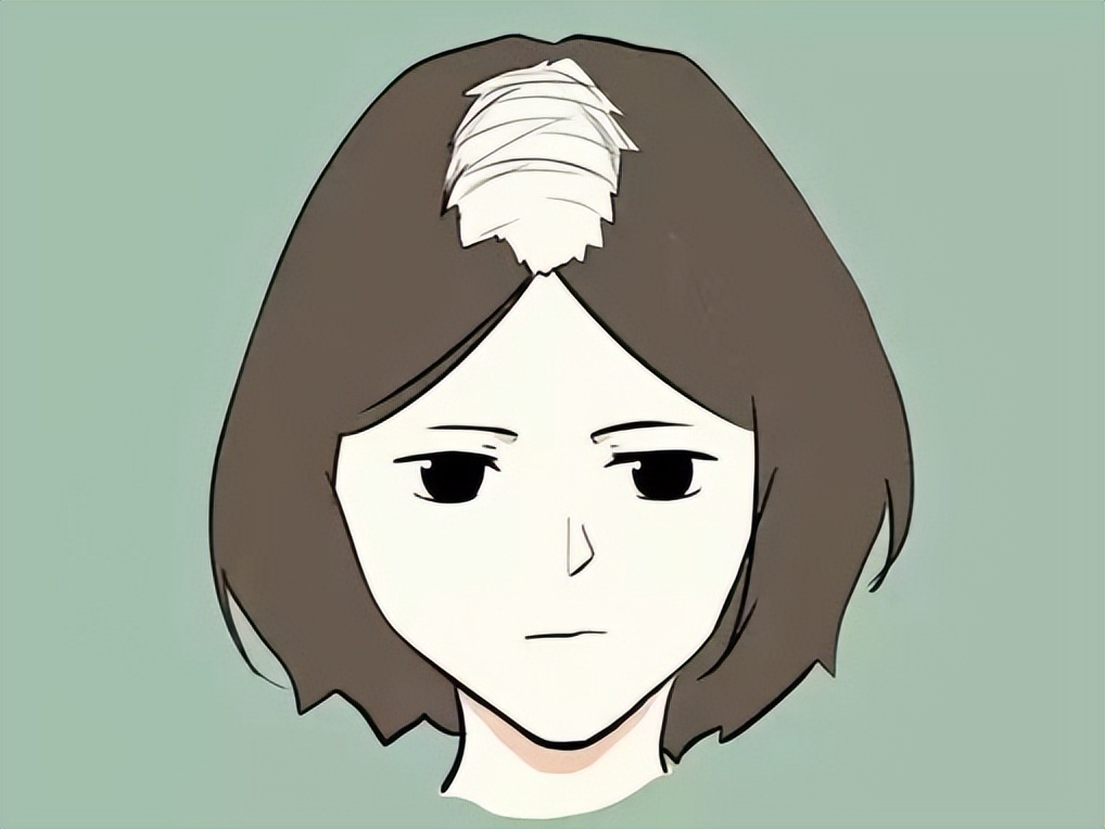 20多岁雄性激素脱发,20男生就脱发秃顶了