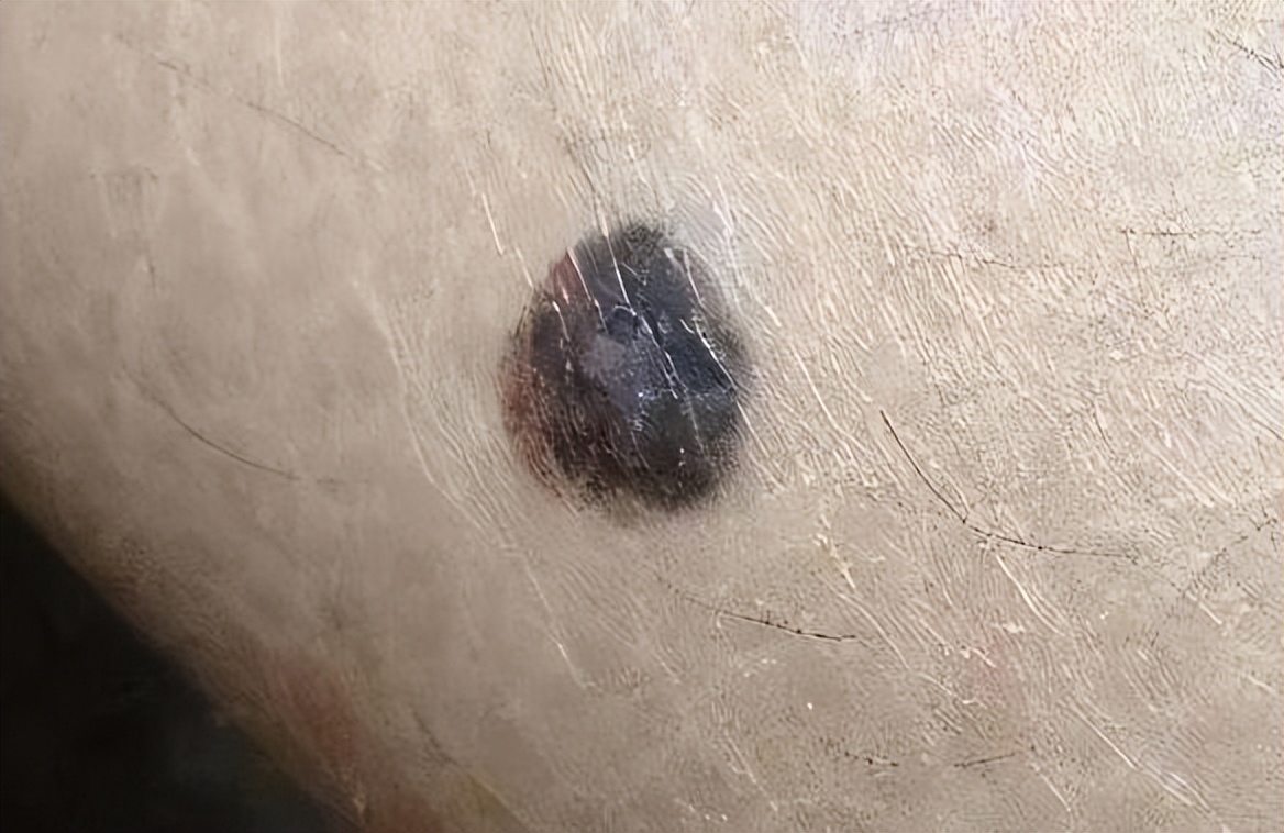 黑痣上长毛是好痣还是坏痣,脸上有个凸出的黑痣是好痣吗