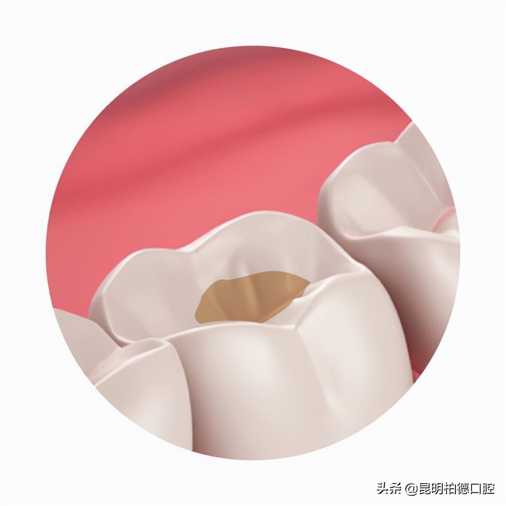 牙齿补牙后注意事项,补牙后如何正确维护牙齿