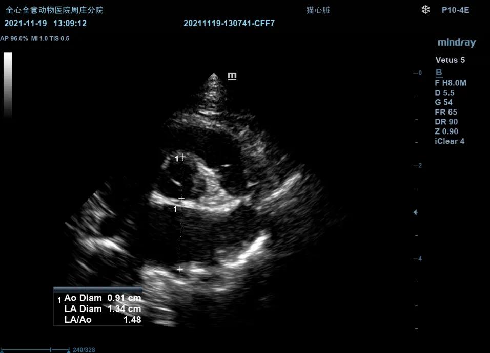 二尖瓣发育不良病例总结