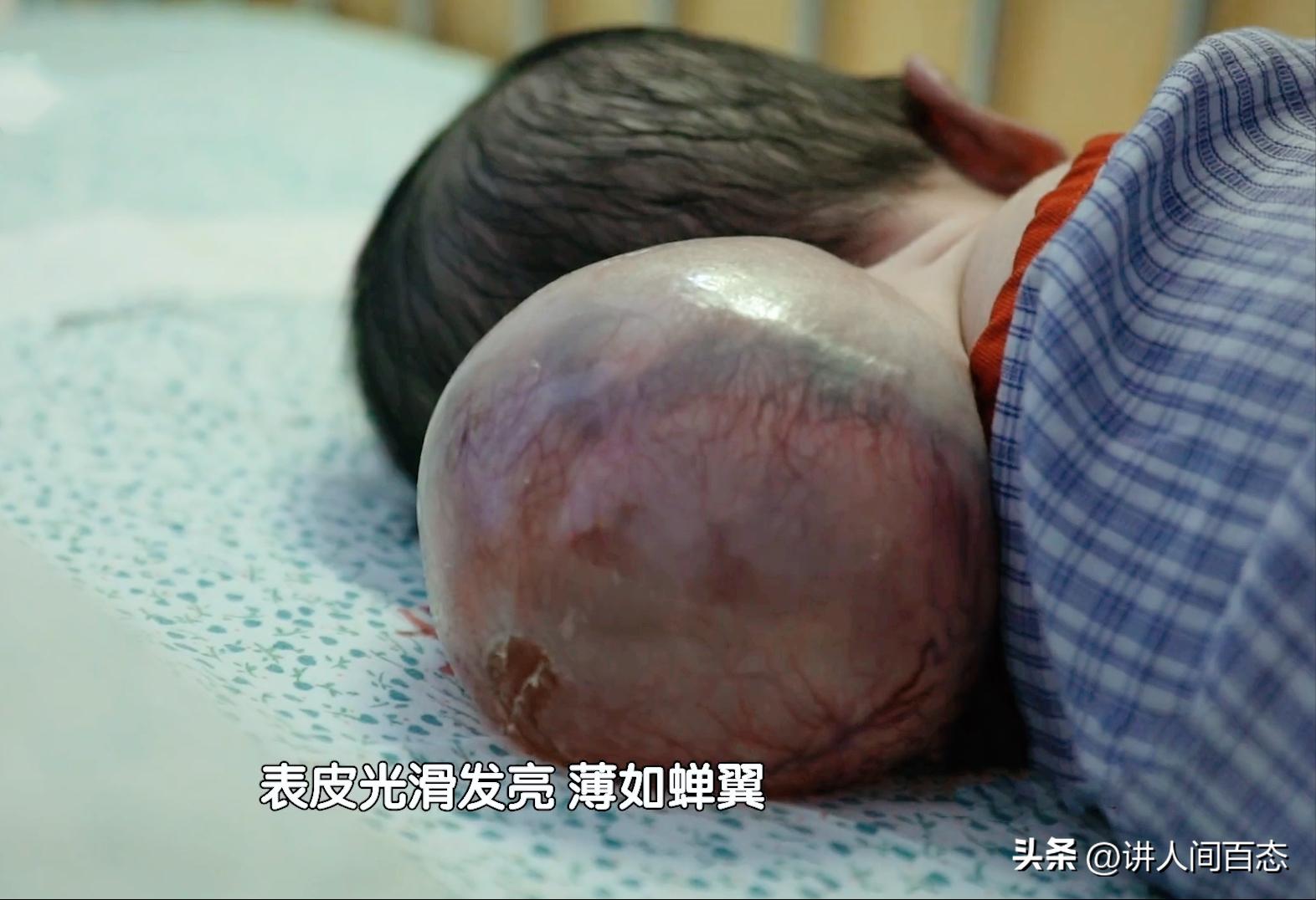 被丢在桥洞下的孩子后续,孩子被遗弃后脑长肿瘤