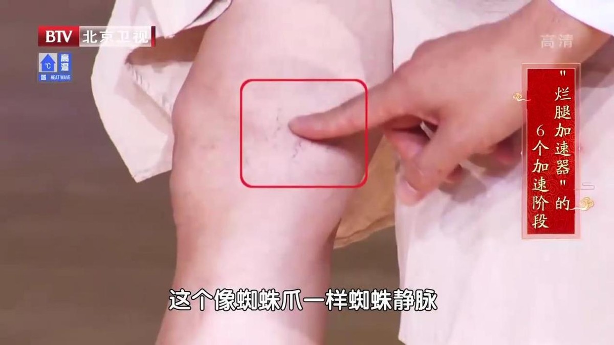 单腿小腿酸胀发麻是静脉曲张吗,腿酸胀难受怎么缓解静脉曲张