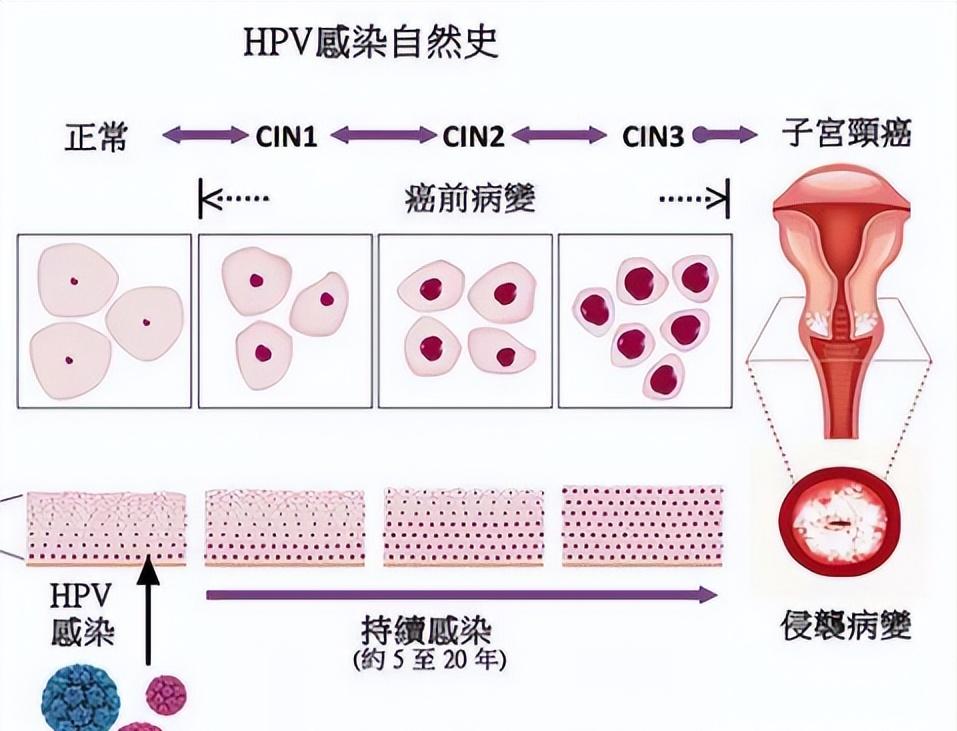 HPV病毒阳了之后哪几个型号会长疣？
