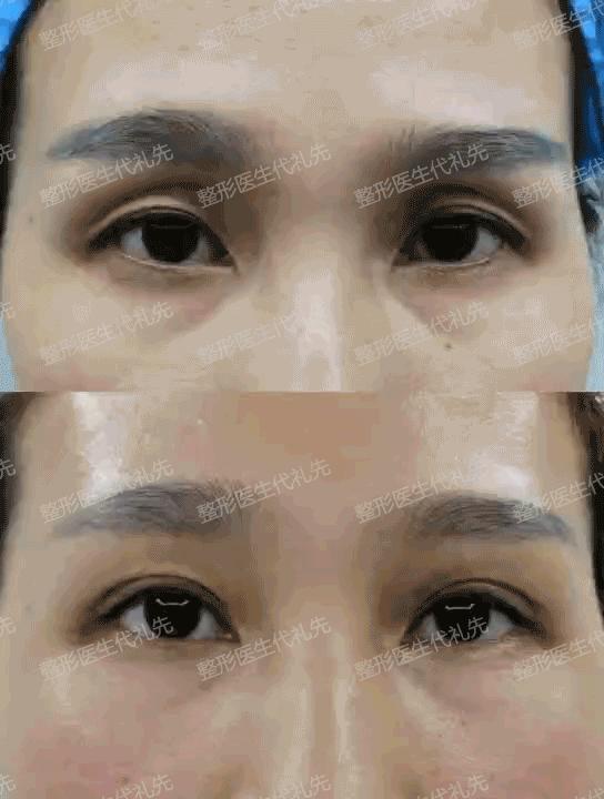 上眼窝凹陷下眼窝水肿怎么回事,眼窝凹陷眼周脂肪填充眼窝可以吗