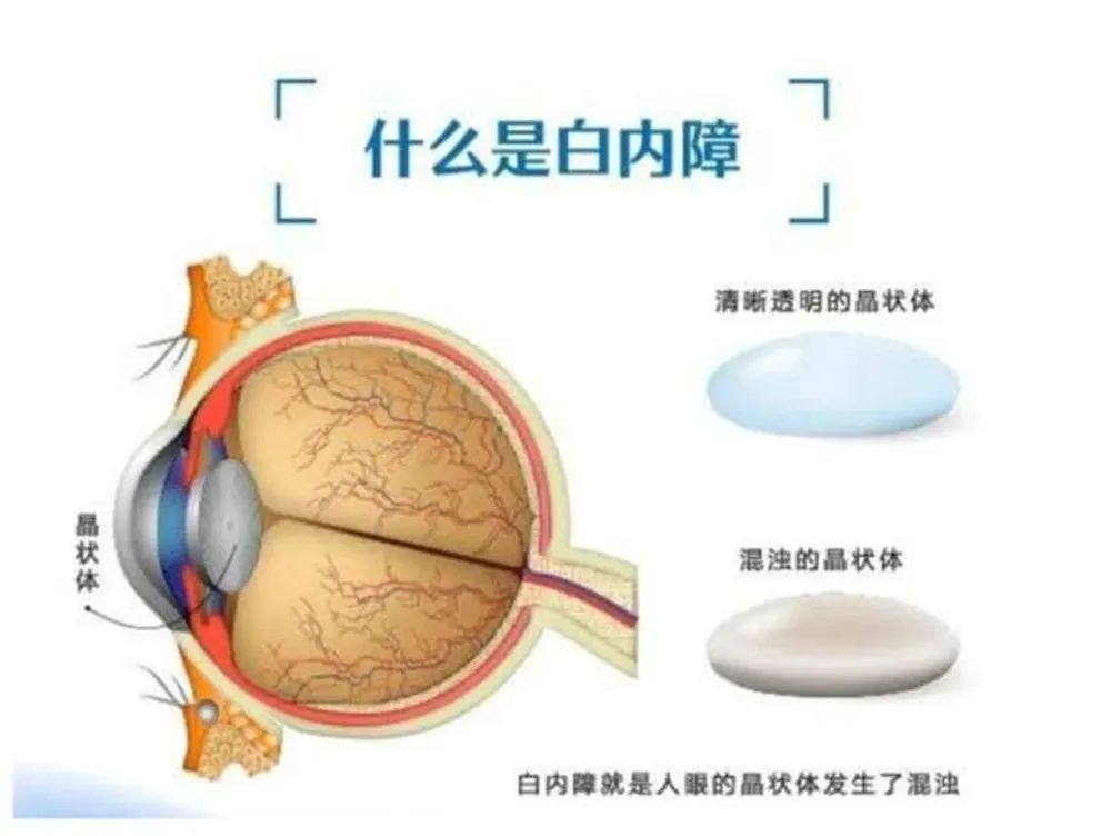 如何读懂白内障患者的验光单,一文读懂光芯片