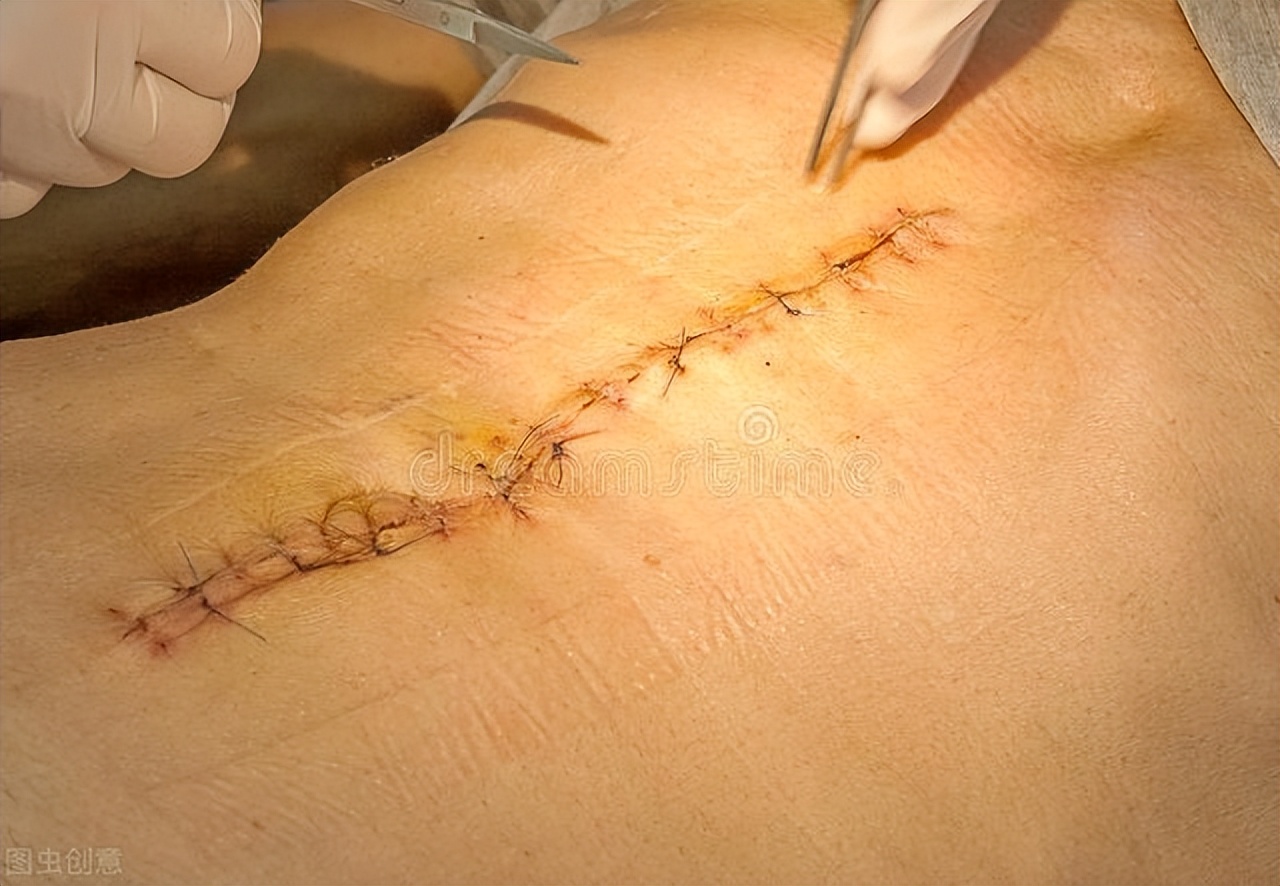 祛疤膏需要多长时间才能祛除疤痕,祛疤最佳治疗期