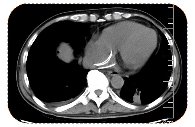 病例分享丨晚期肝癌治疗新策略，把不可能变为可能！