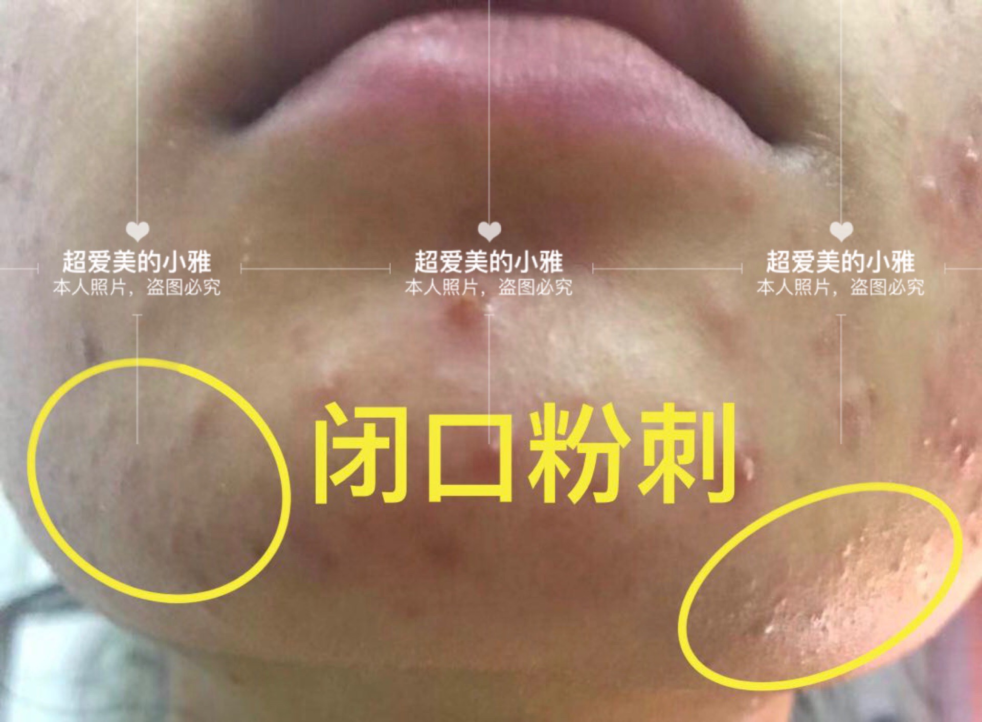 痘痘严重爆发如何战痘到底,痘痘的常见问题解决方法在这里