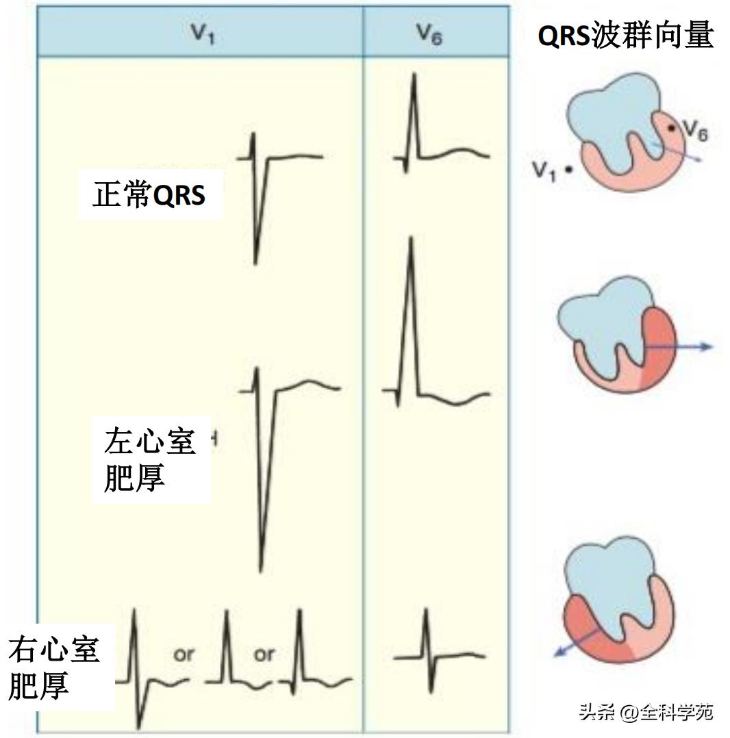 心电图笔记26：QRS波振幅变高，需要想到哪些