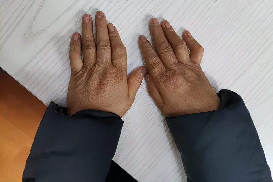 类风湿患者自述疼痛过程,如何减轻类风湿疼痛