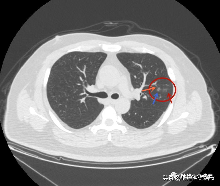 如何判断肺磨玻璃结节是高危结节,肺上有混合磨玻璃结节要注意什么