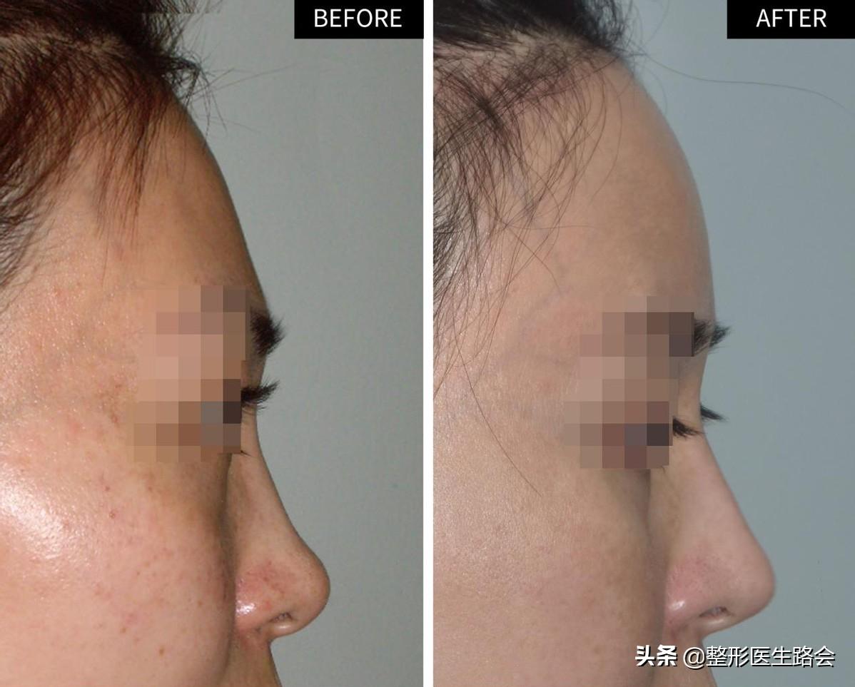 填充额头为什么额头有坑,填充额头过度饱满怎么消除