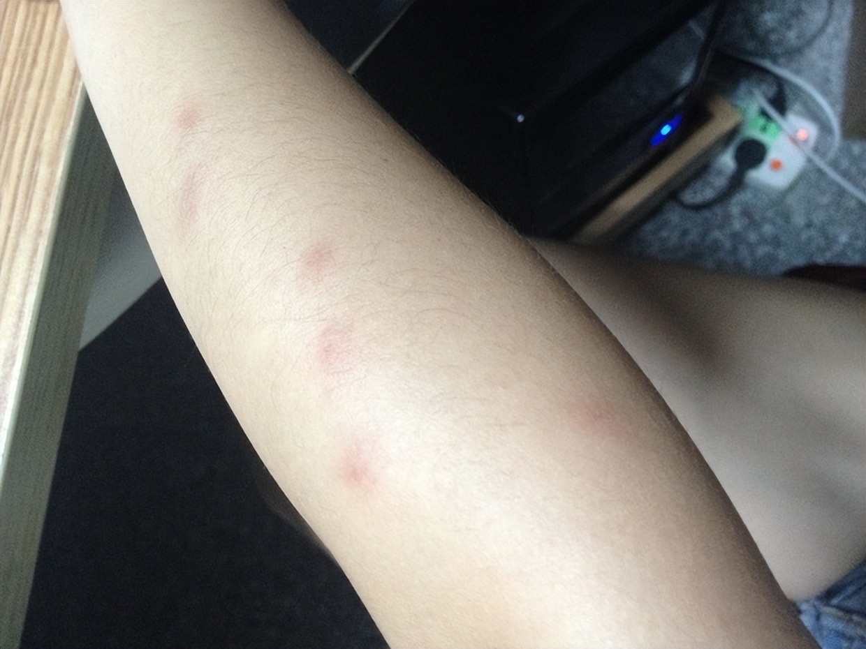 5个月宝宝皮肤破皮怎么办,5个月宝宝手臂烂