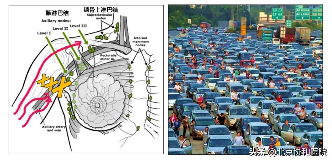协和医院乳腺淋巴水肿,乳腺癌术后淋巴水肿专家共识