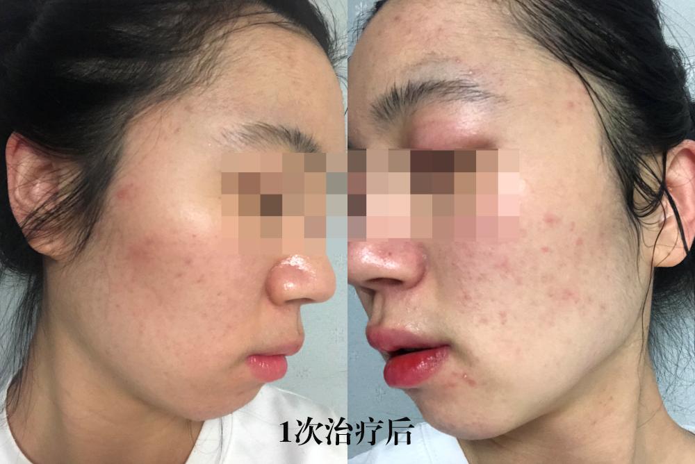 五年的痘坑能用生长因子吗,五年的痘印怎么祛除