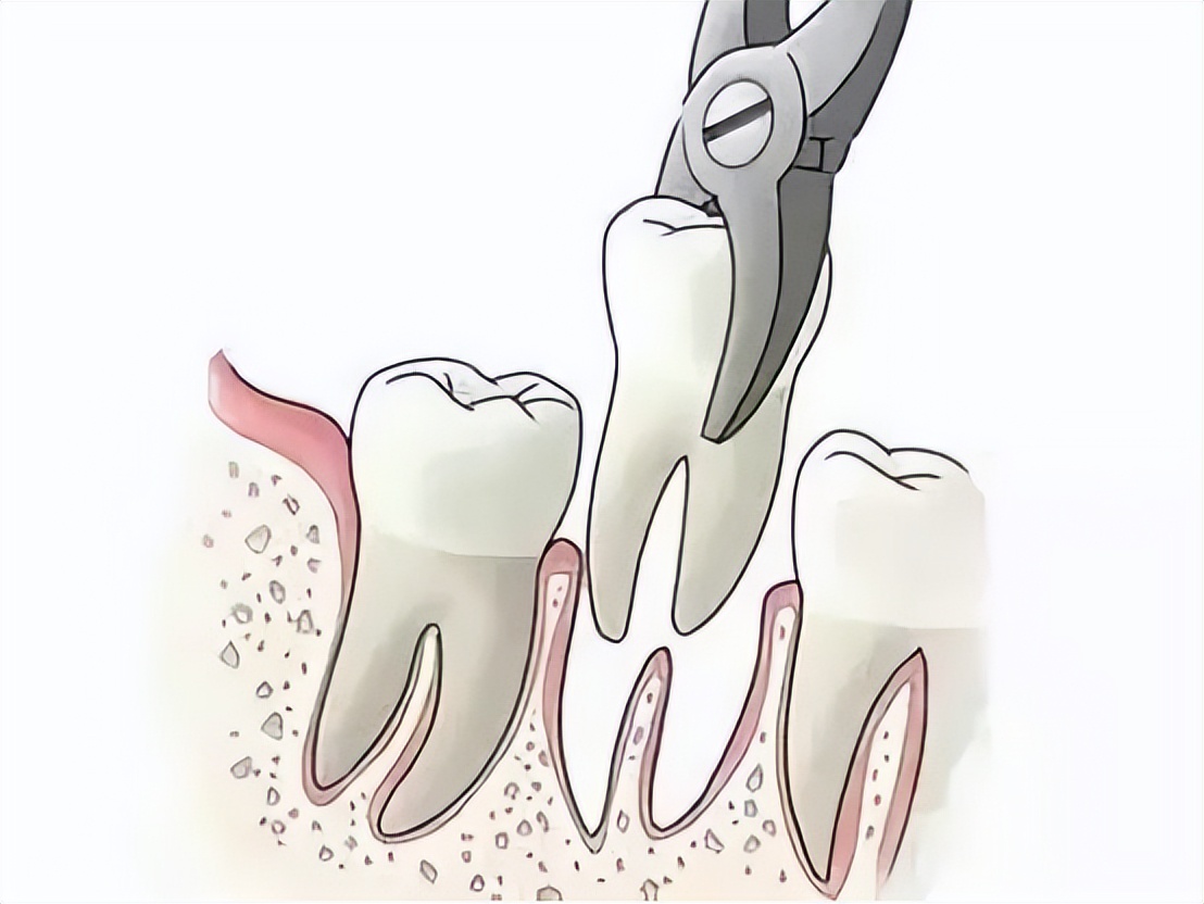 拔牙之后怎么护理口腔,拔牙后怎么护理记住这6点就够了