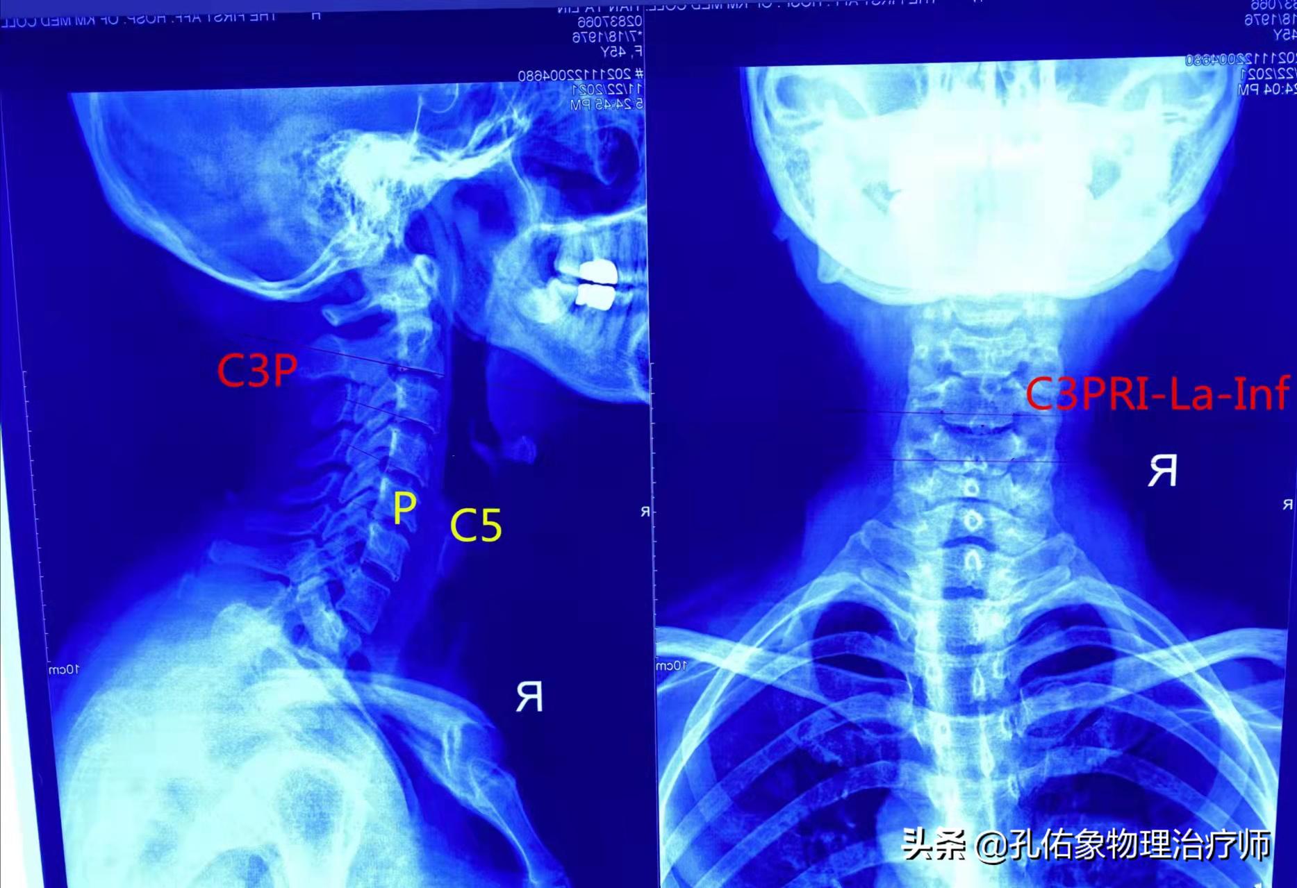 肩胛骨痛点变位置了,肩胛骨痛点怎么治