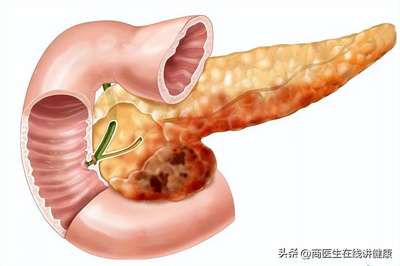胰腺癌发现就是晚期吗,胰腺癌晚期出现打嗝症状怎么治疗