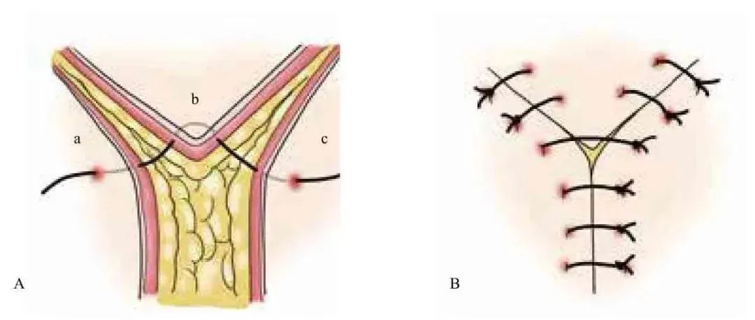 3分钟get:真正的外科缝合秘籍