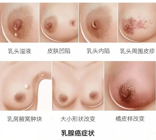 如果没有这个现象，乳房一大一小是正常的