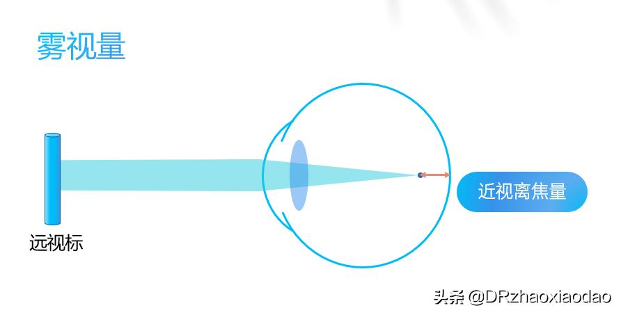 雾视镜防控近视真的有用吗,雾视屏治疗近视眼真的吗