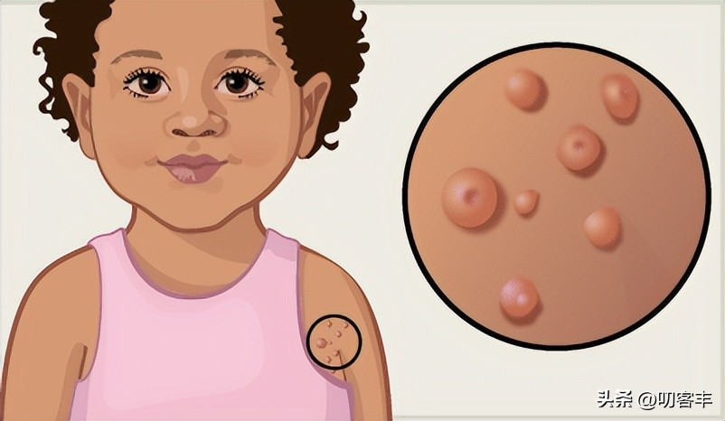 传染性软疣儿童怎么治,传染性软疣怎么好得最快