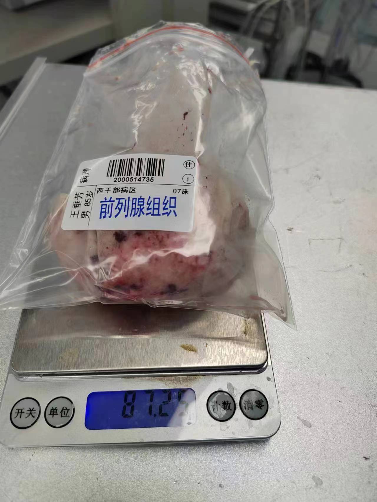 前列腺钬激光剜除术动画,同济医院有前列腺钬激光剜除术