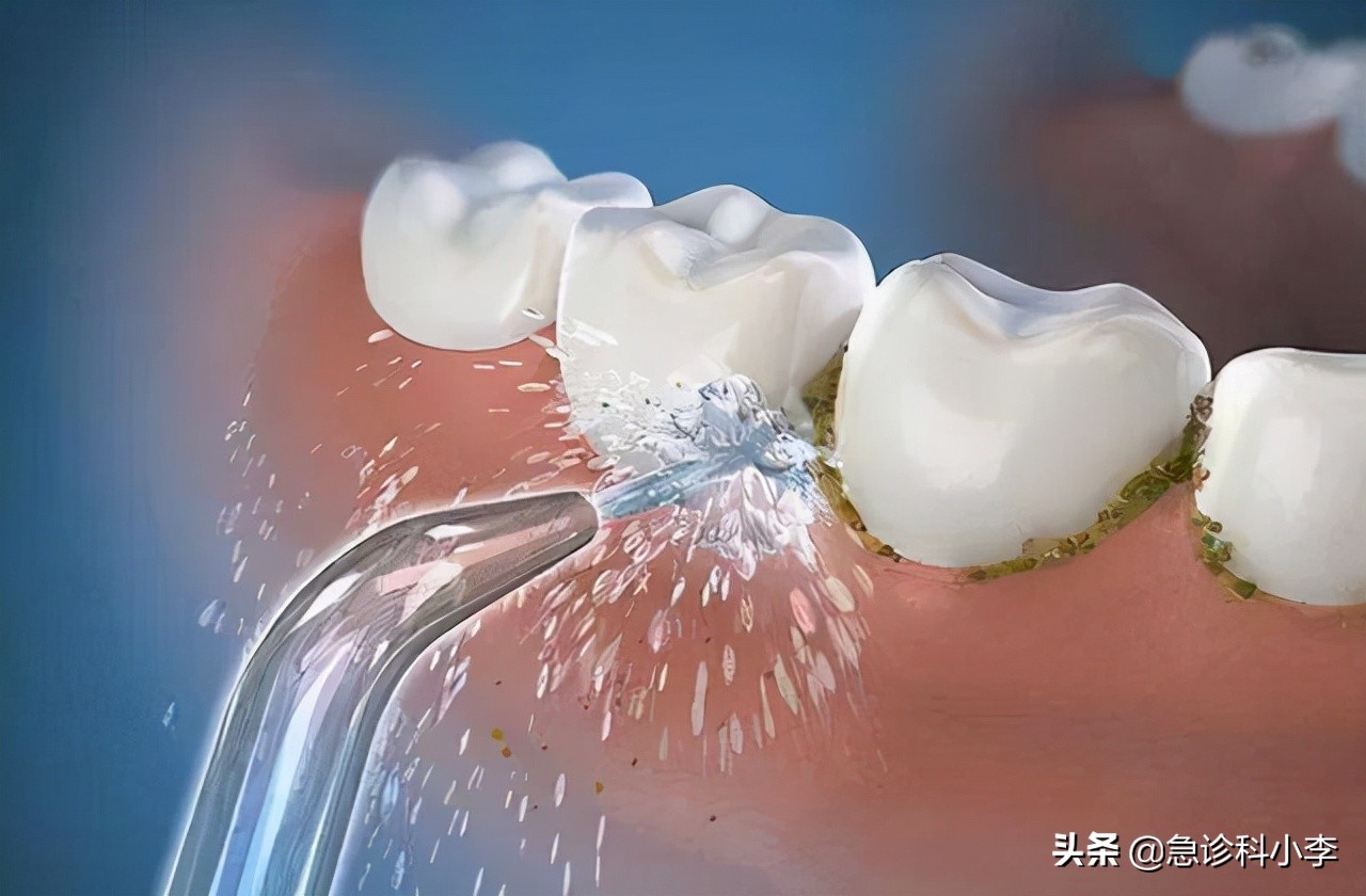 在牙缝里的牙结石要怎么去除,牙缝的牙结石怎么自己去除