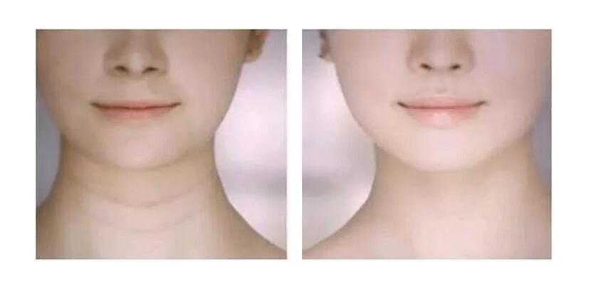 颈纹特别深的年轻女人,颈纹很显老手把手教你小妙招