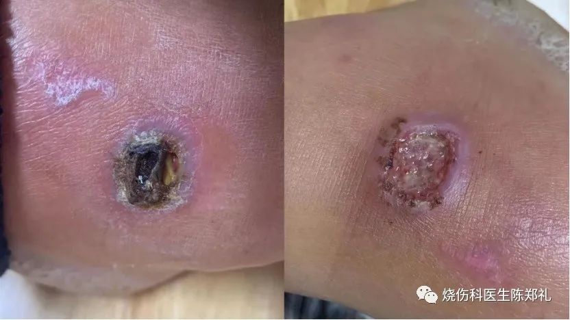 慢性创面患者的敷料运用及选择,创面换药敷料的选择