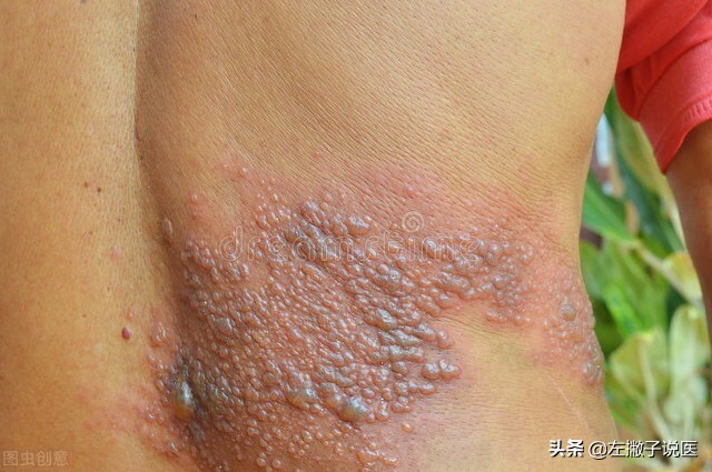 一旦感染,一旦感染终身携带是什么意思