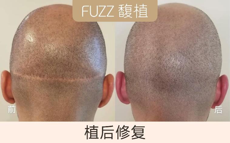 熬夜脱发怎么办最有效,熬夜脱发怎么办最有效的办法