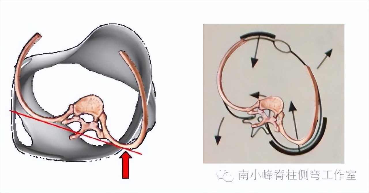 脊柱侧弯多少度会形成剃刀背,脊柱侧弯多少度会出现剃刀背