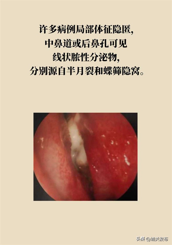 鼻子发霉怎么办,鼻子里因为异物发臭用什么药处理