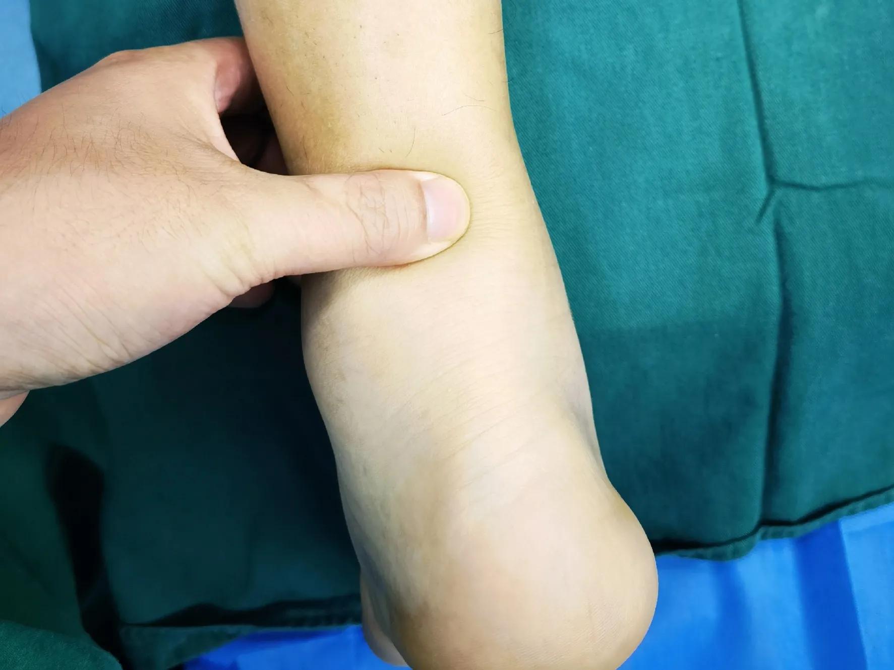 跟腱断裂的微创治疗,跟腱断裂微创手术修复演示图