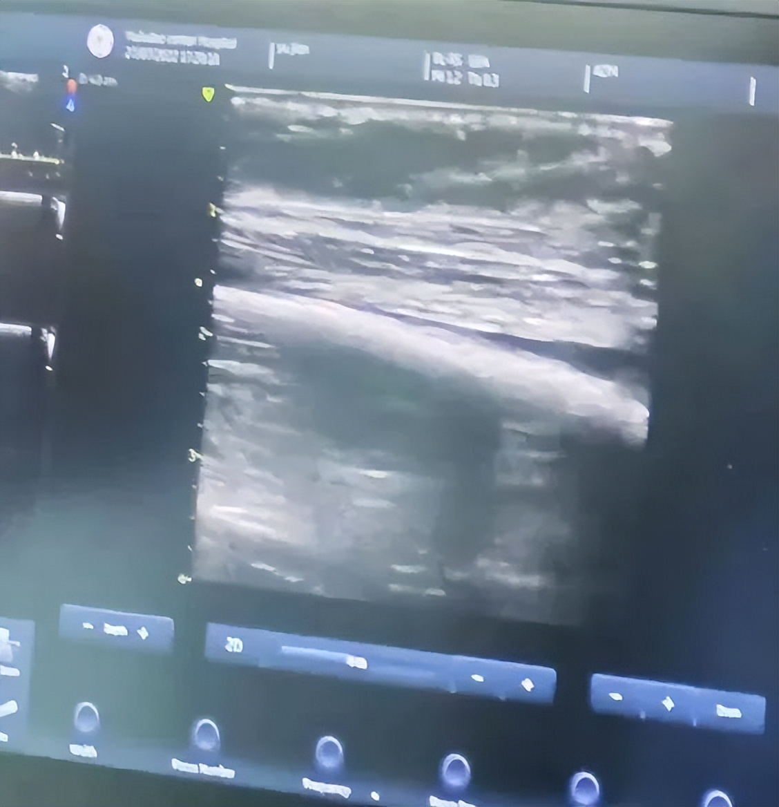 医院开展首例自体动静脉内瘘手术,自体动静脉内瘘超声评估