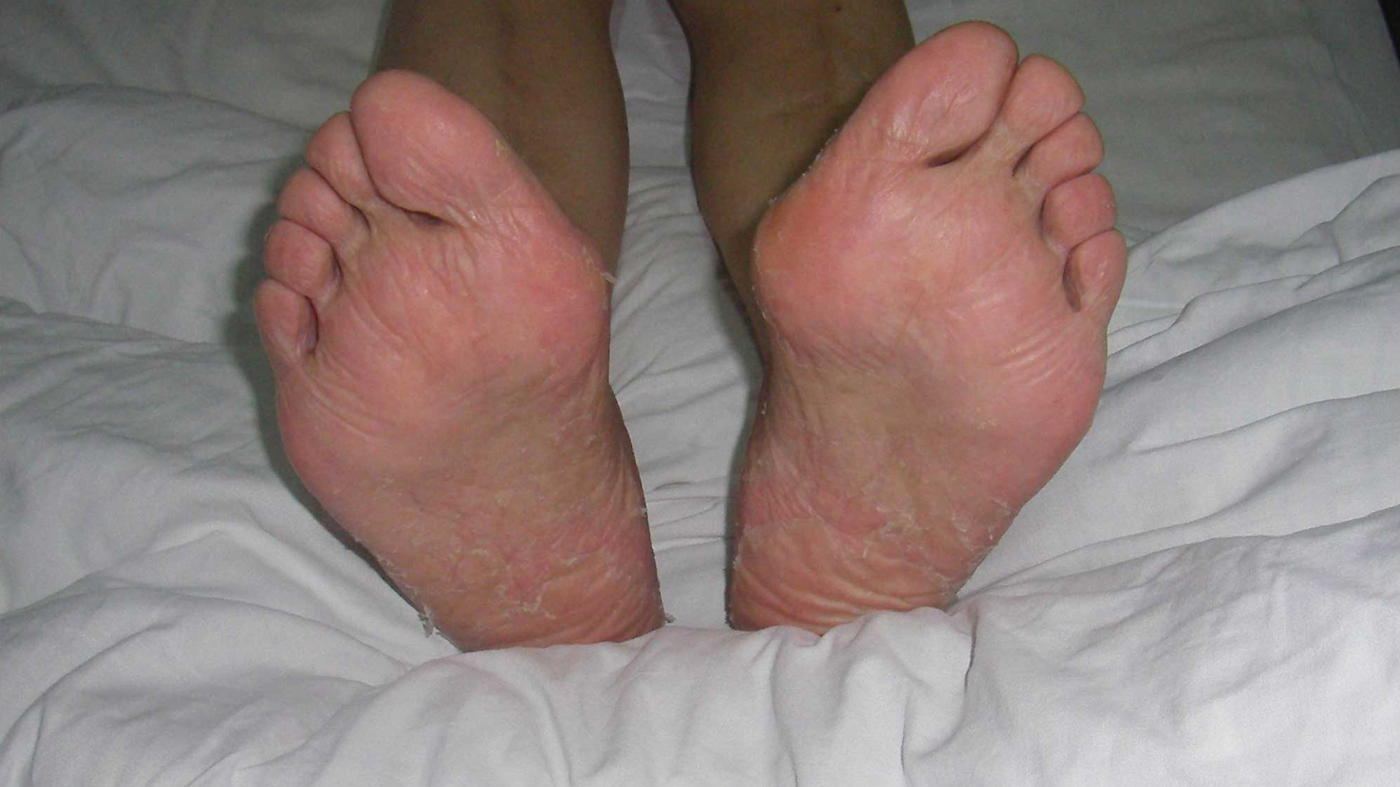 乳房一会侧边疼一会上边疼,乳腺化疗手脚红肿痒怎么办