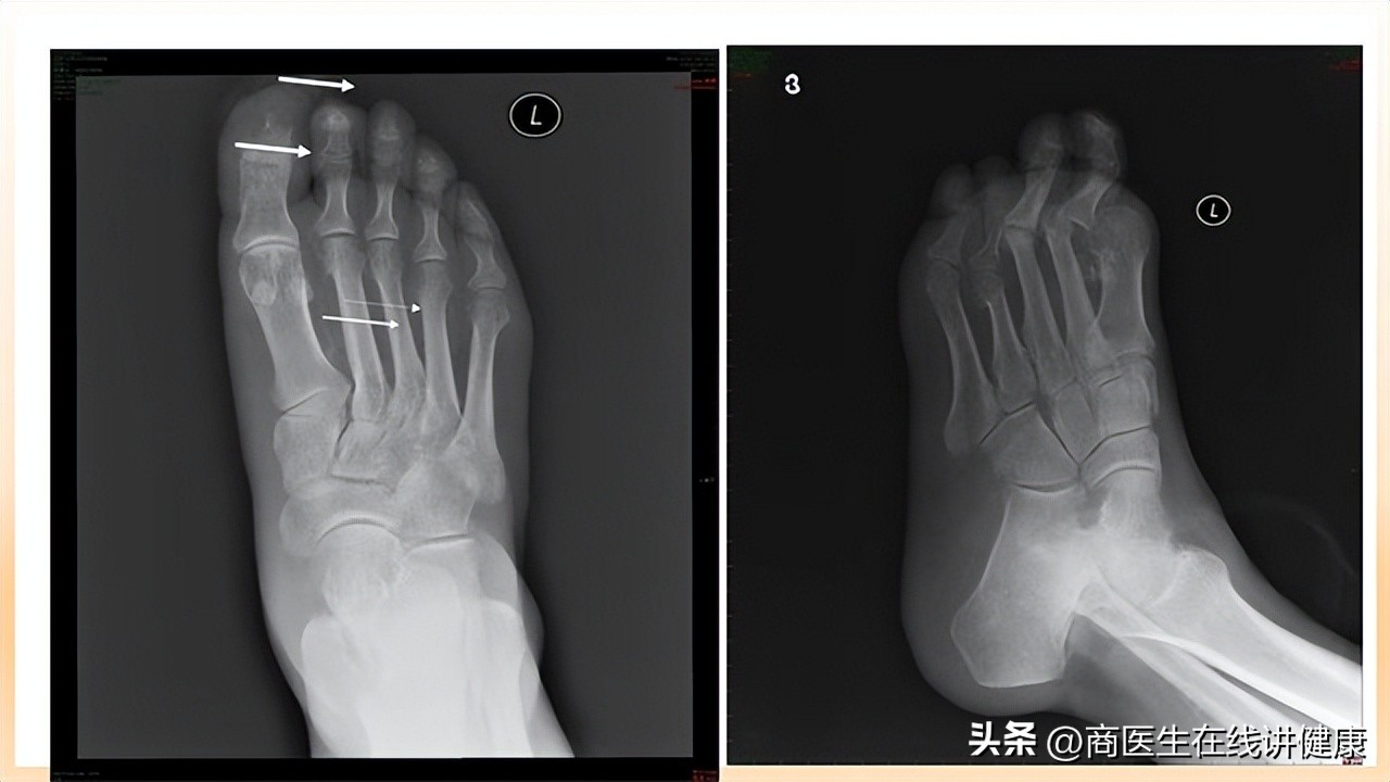 怎样防止糖尿病足,糖尿病足出现三种情况要注意了