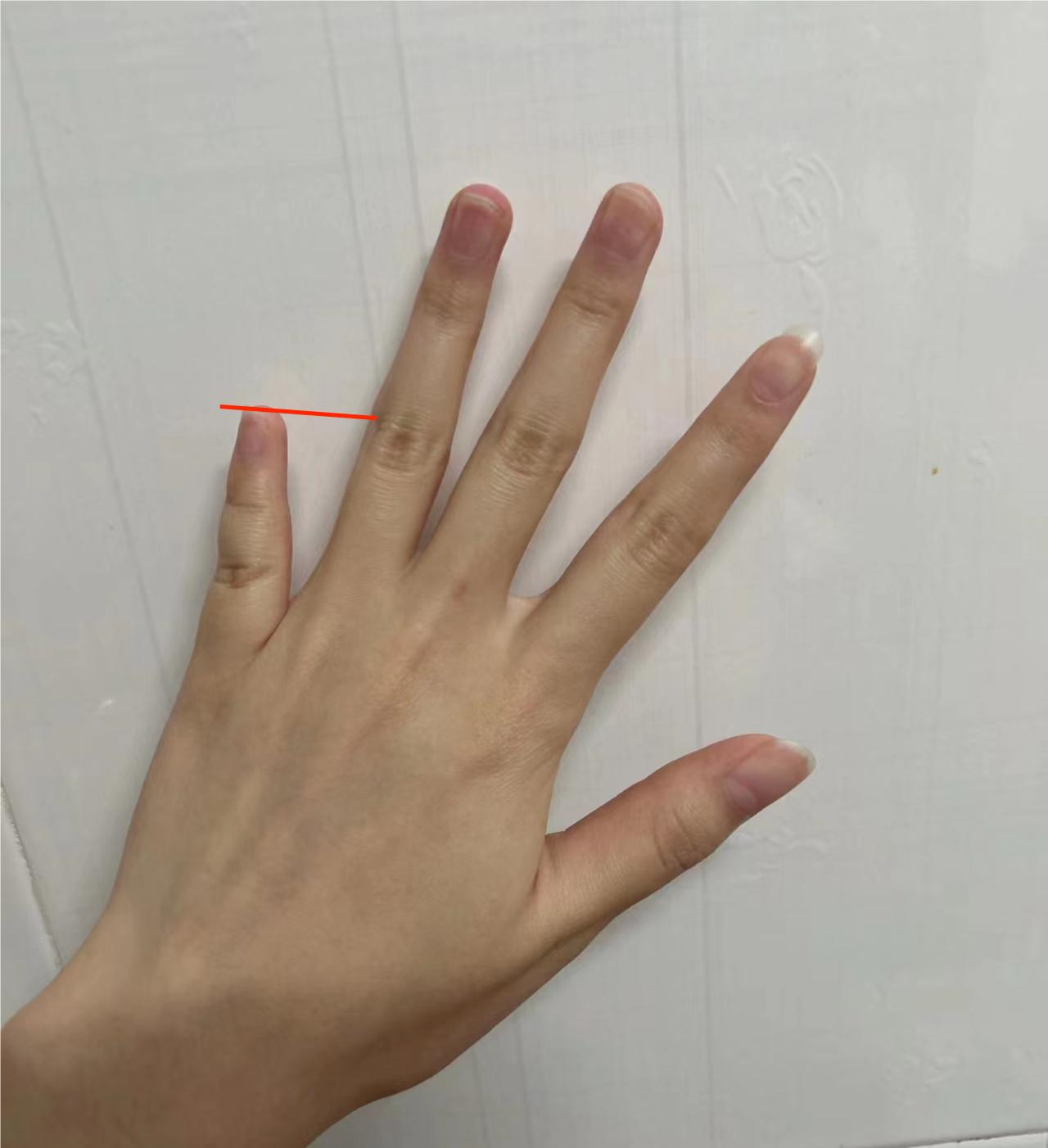 手指的小指很短是怎么回事,小拇指短是什么型短指症