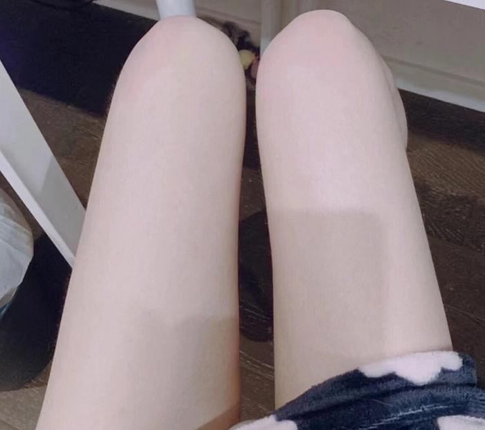 肥胖纹目前最好的去除办法,淡化肥胖纹修复肥胖纹