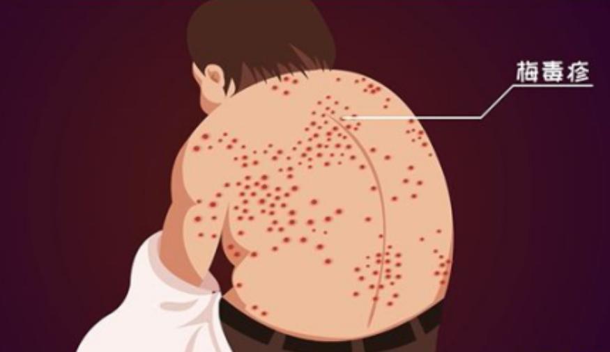 得了梅毒有什么症状？身上会痒吗？梅毒可以治愈吗？建议了解一下