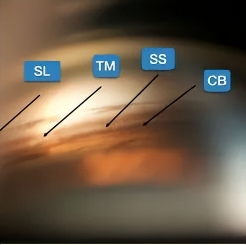 「世界青光眼周」|一文盘点青光眼诊疗新进展,让世界更“睛”彩