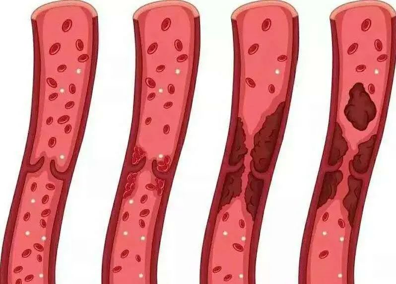 下肢静脉血栓患者能做康复训练吗,膝盖手术后下肢静脉血栓康复训练