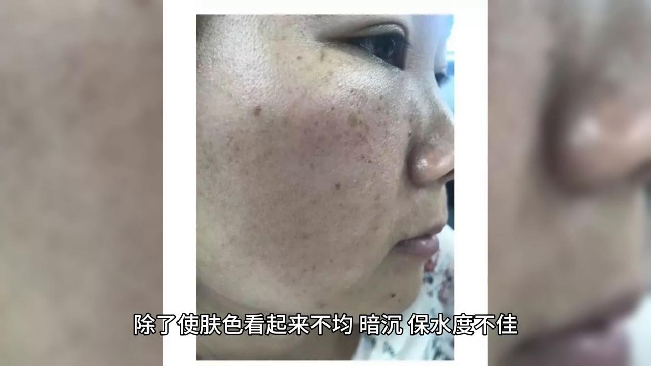 角质层太厚怎么办,角质层太厚是不是也会显黑