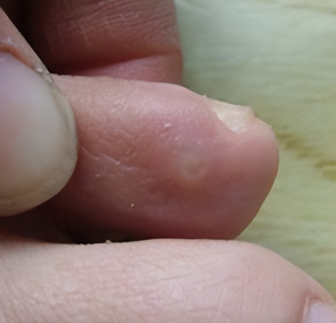 鸡眼瘊子和跖疣的区别,鸡眼跖疣傻傻分不清楚