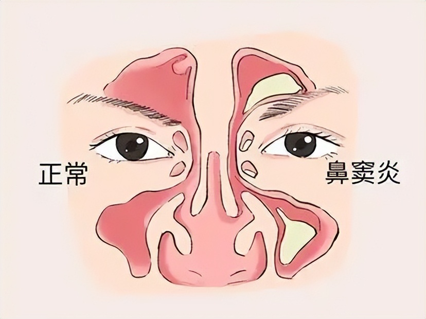 盐水怎么洗鼻子治疗鼻炎,盐水洗鼻炎副作用