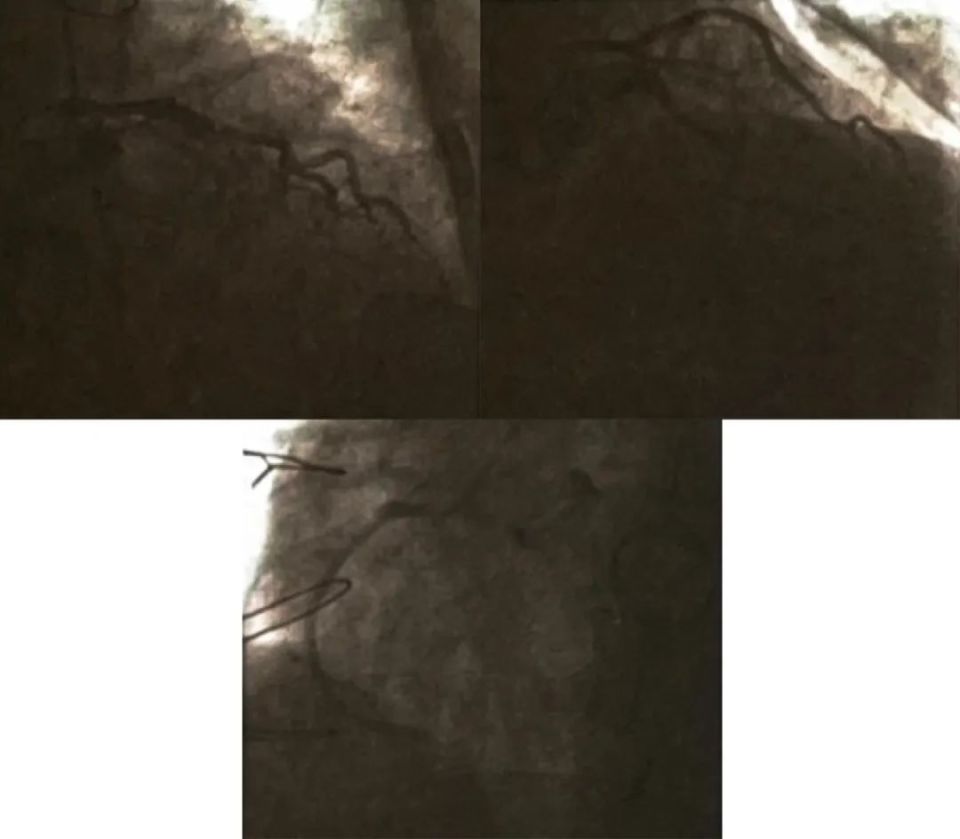 瓣膜置换术后心率快怎么办,瓣膜置换后如何预防心梗