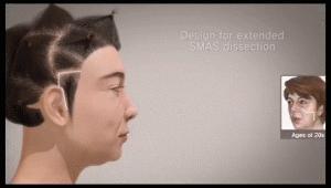 美容都打什么针能除皱,面部拉皮除皱哪家效果好